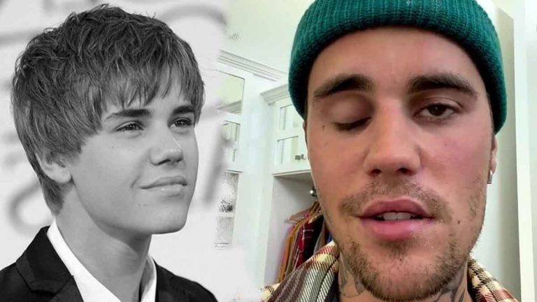 Justin Bieber amputé avec le visage défiguré